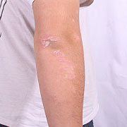 Cuidades-psoriasis