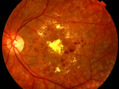 retinopatia