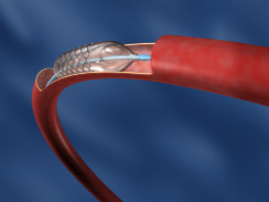 angioplastia