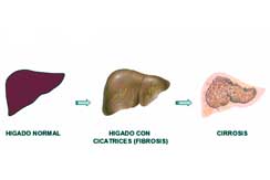 Enfermedades del higado int1