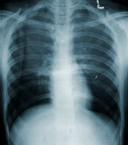 pulmones-i