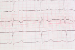 epilepsia-3-i