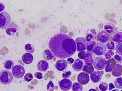i-nanofármaco-contra-leucemia-unam