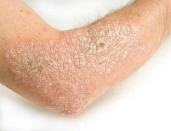 psoriasis-I