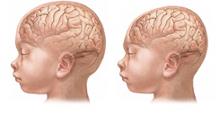Ilustración izquierda: cabeza normal. Ilustración derecha: microcefalia / Fuente: National Library of Medicine