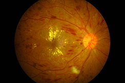 retinopatia-diabetica-cliki-2