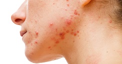 acne-efectos-2