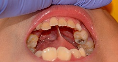 caries-2