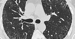 idiopathic-pulmonary-fibrosis-3