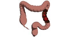 cancer-colon-reducir-riesgo-2