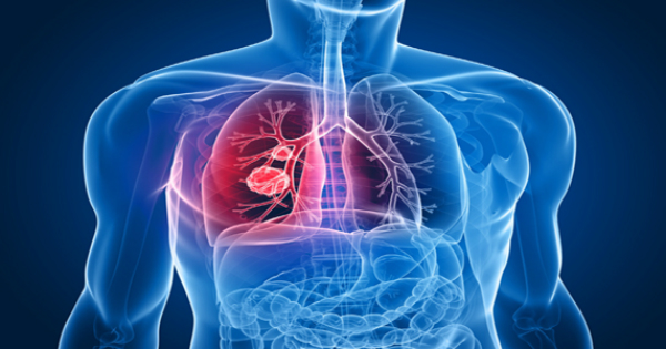 Cáncer de pulmón
