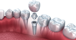 Implantes dentales