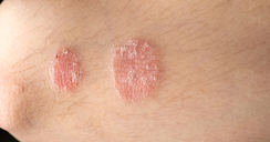 Dermatólogo Psoriasis