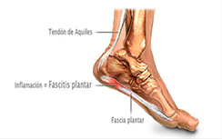 fascitis plantar-2