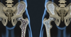 Osteoporosis