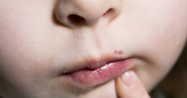Si Tu Hijo Tiene Ampollas En El Rostro Y Las Manos Podria Tratarse De Esto Clikisalud Net Fundacion Carlos Slim