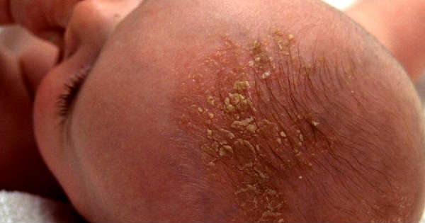 Costra Láctea o dermatitis