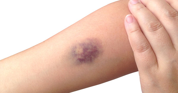 4 factores que provocan hematomas de fácil aparición