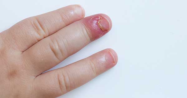 comprador llave inglesa Dar una vuelta Tips para prevenir una infección de dedo durante el confinamiento
