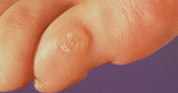 3 maneras de remover callos del dedo meñique del pie por tu cuenta