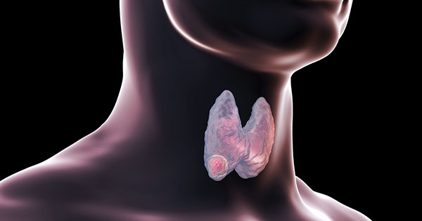 Cáncer de tiroides, información clave que debes conocer