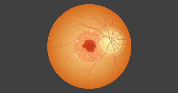 Glaucoma Neovascular qu Es Y Cu les Son Sus Causas Glaucoma Neovascular qu Es Y Cu les Son Sus Causas